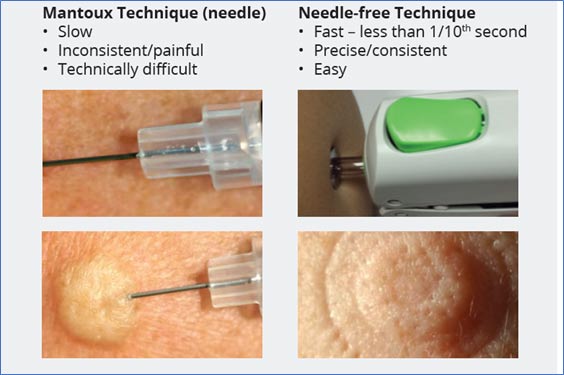 Mantoux Technique - Slow, Inconsistent/painful, Technically difficult; Needle-Free Technique - Fast – less than 1/10th second, Precise/consistent, Easy